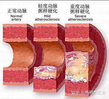 動脈硬化怎麼回事它是心血管疾病的罪魁禍首如何用飲食控制