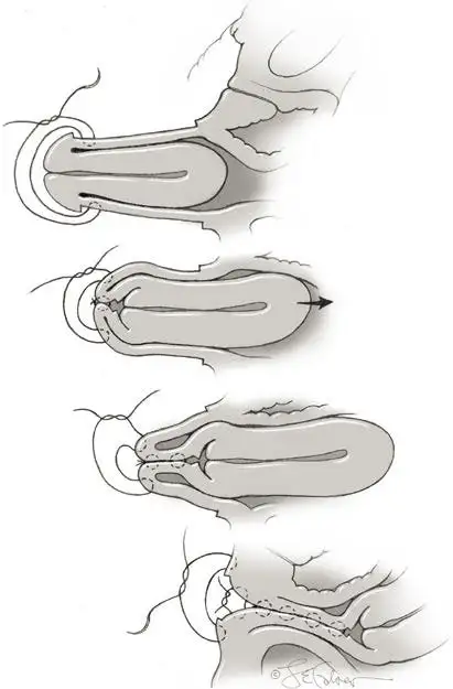 老年妇女子宫脱垂(子宫下垂)现在有多少治疗方案,利弊分析?