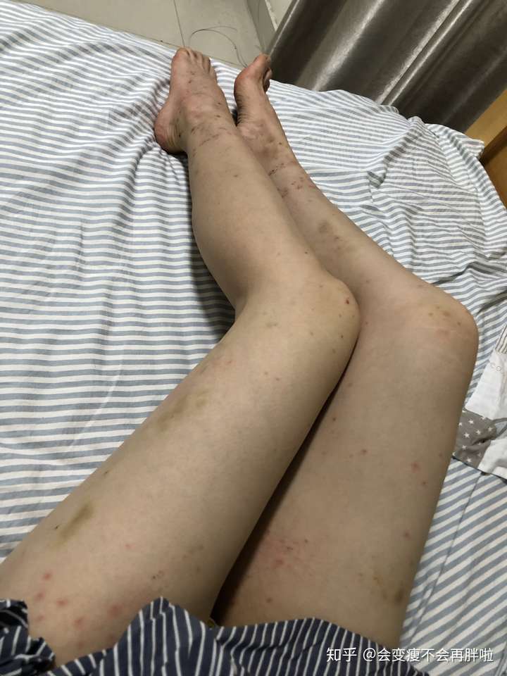 被跳蚤咬的全身都是包是什么样的感受!