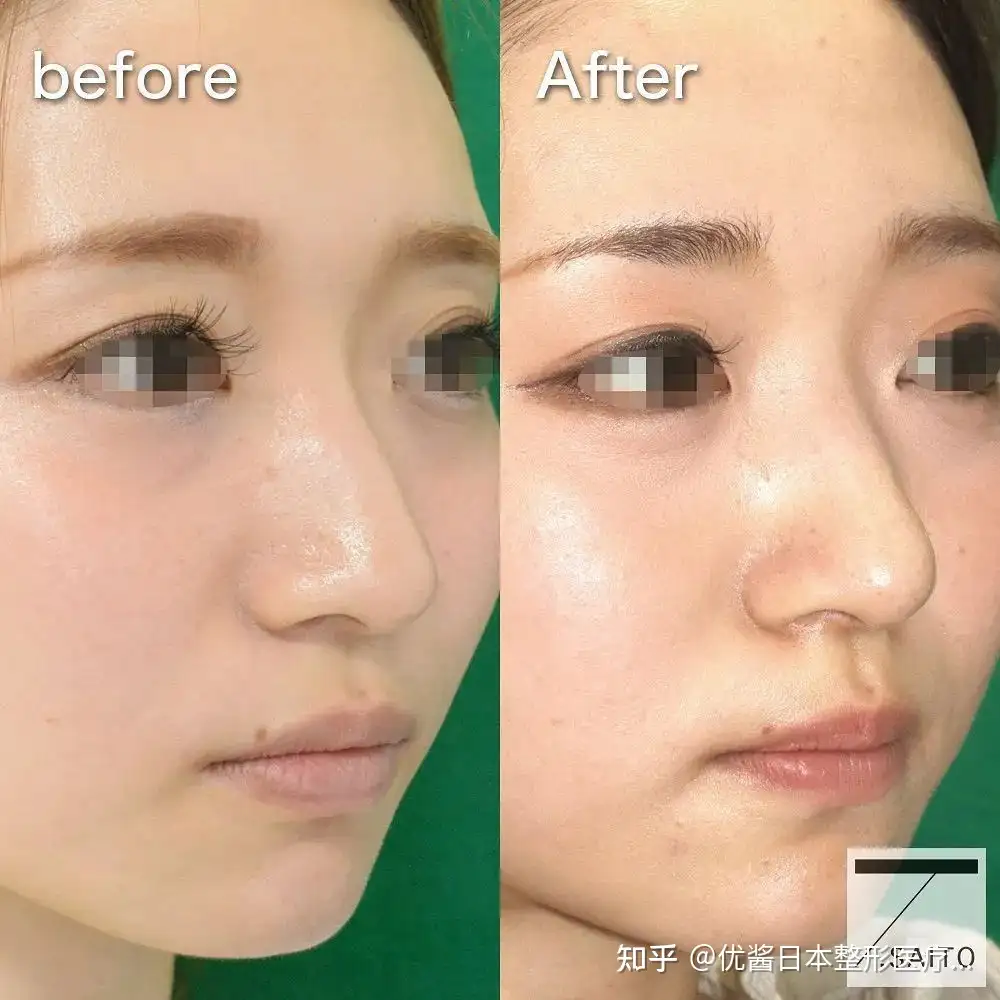 その他 鼻形成術 Rebuilding Nose 教科書 【一部予約!】 | i4us.com.br