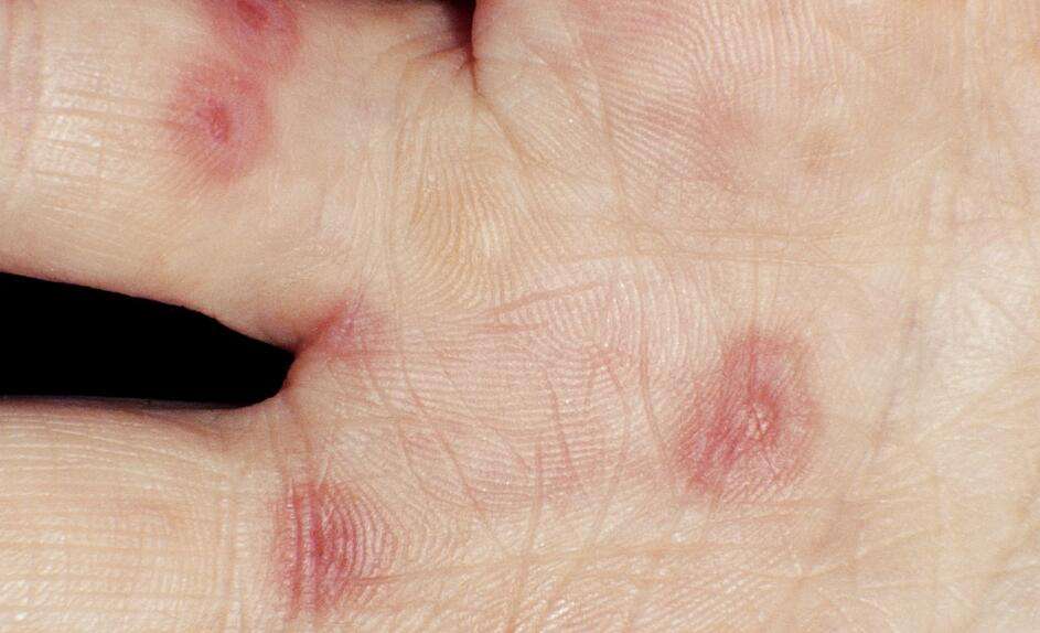 皮肤医生李志忠 的想法: 能治多形性红斑(血风疮),丹毒初起,紫癜