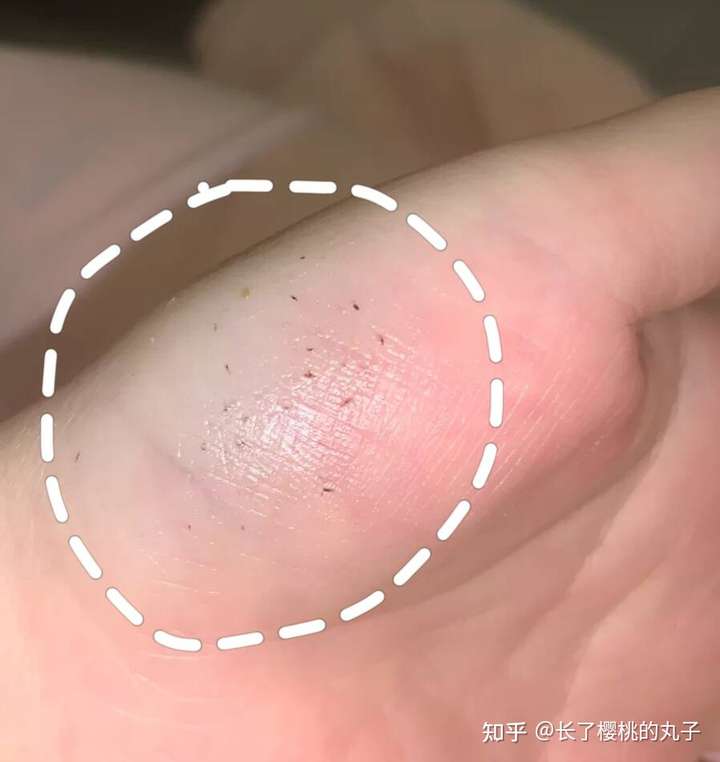 挤黑头有坏处吗