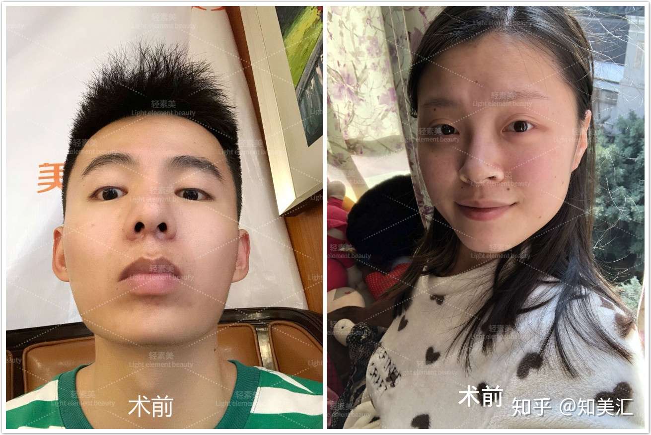 干货篇 男士做下颌角手术的体验感 知乎