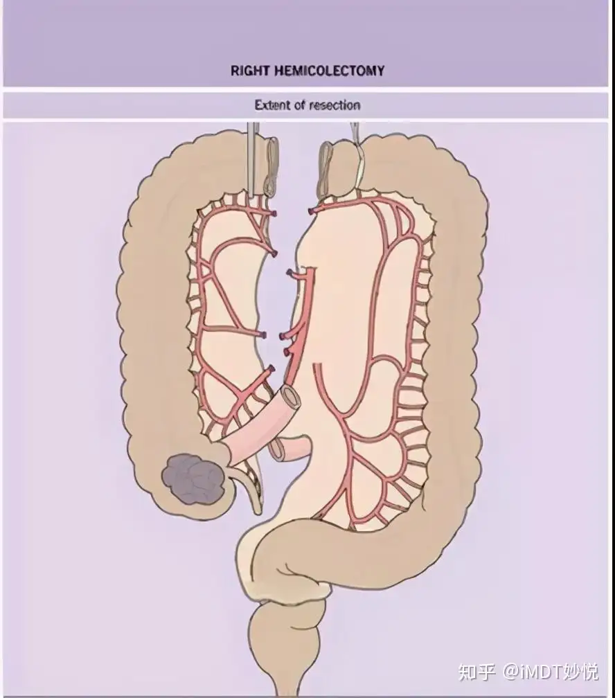 结直肠癌不同手术方式的对比和适应症选择- 知乎