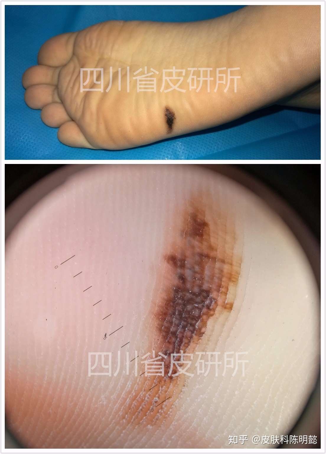 人各有 痣 何以处之 知乎