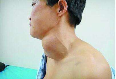 甲状腺瘤是怎么引起的 中医能治好吗 知乎