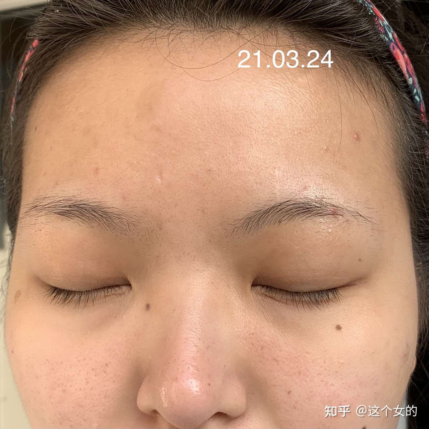 异维a酸停药半年多后复发 真正的勇士就是再吃一次 持续更新 知乎