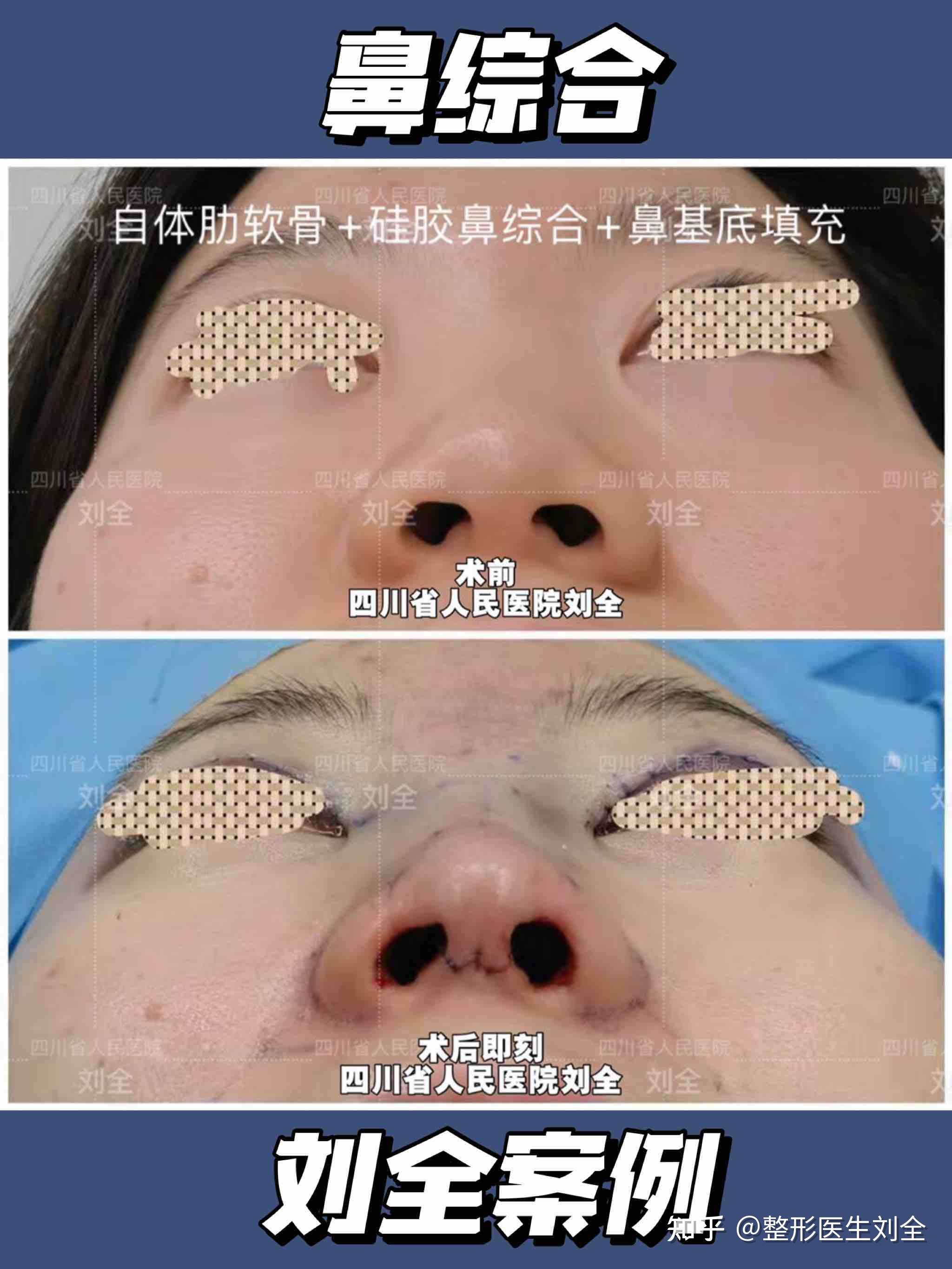 整形医生刘全 的想法: 成都鼻综合术后即刻 【术前情况】 术前鼻