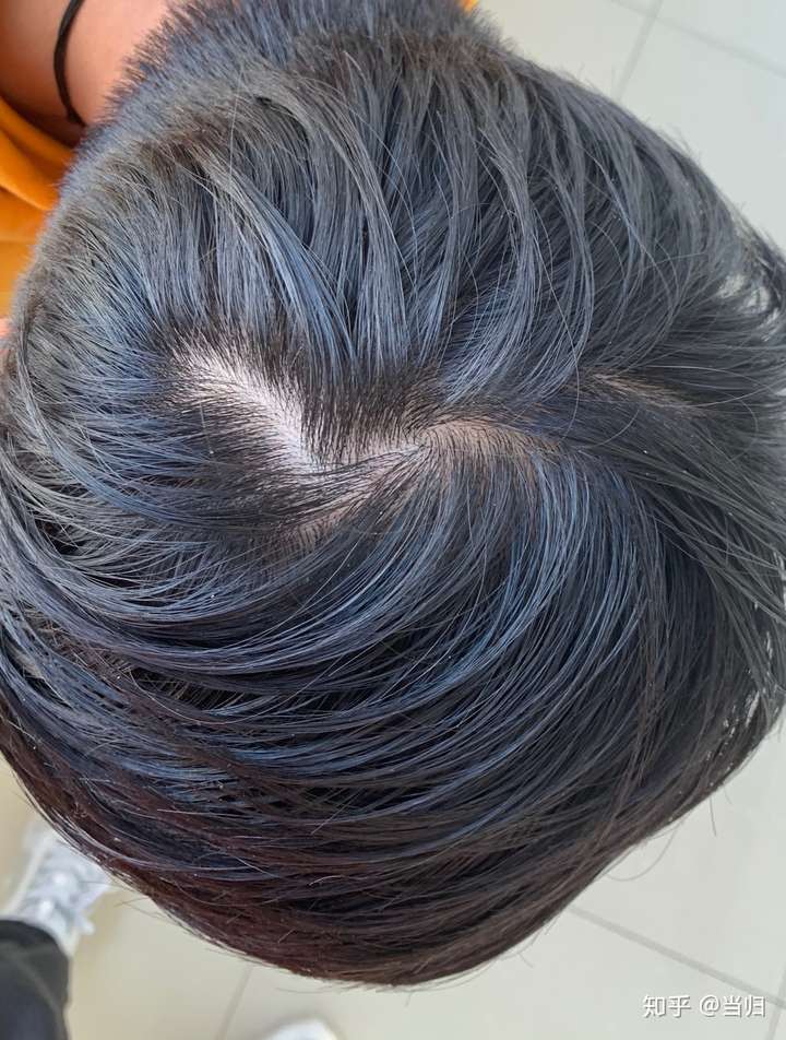 这是脱发吗头顶可以看到头皮