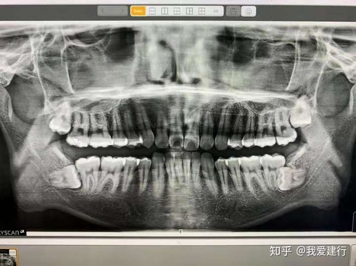 去了附近的牙科诊所拍片发现了两侧下面都有智齿,而且还是埋伏在骨头