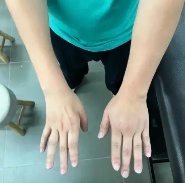 不可忽视的青少年前臂肌肉萎缩