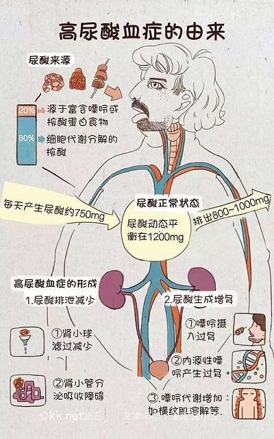 高尿酸血症 看这篇就够了 知乎