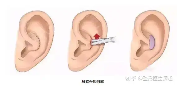 谭超 取耳软骨隆鼻后切口处会不会留下疤痕 知乎 谭超 取耳软骨隆鼻后切口处会不会留下疤痕 知乎