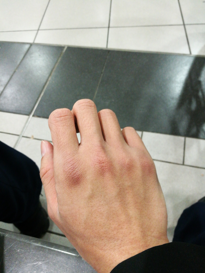 大家的拳茧都啥样了想见见