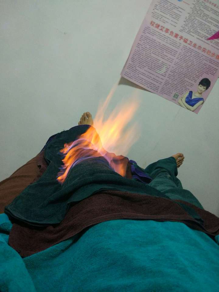 火疗照片