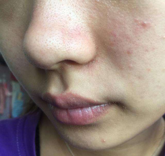 25周岁,混合型皮肤,肤色偏黄,有毛孔,黑头.其他没什么问题.