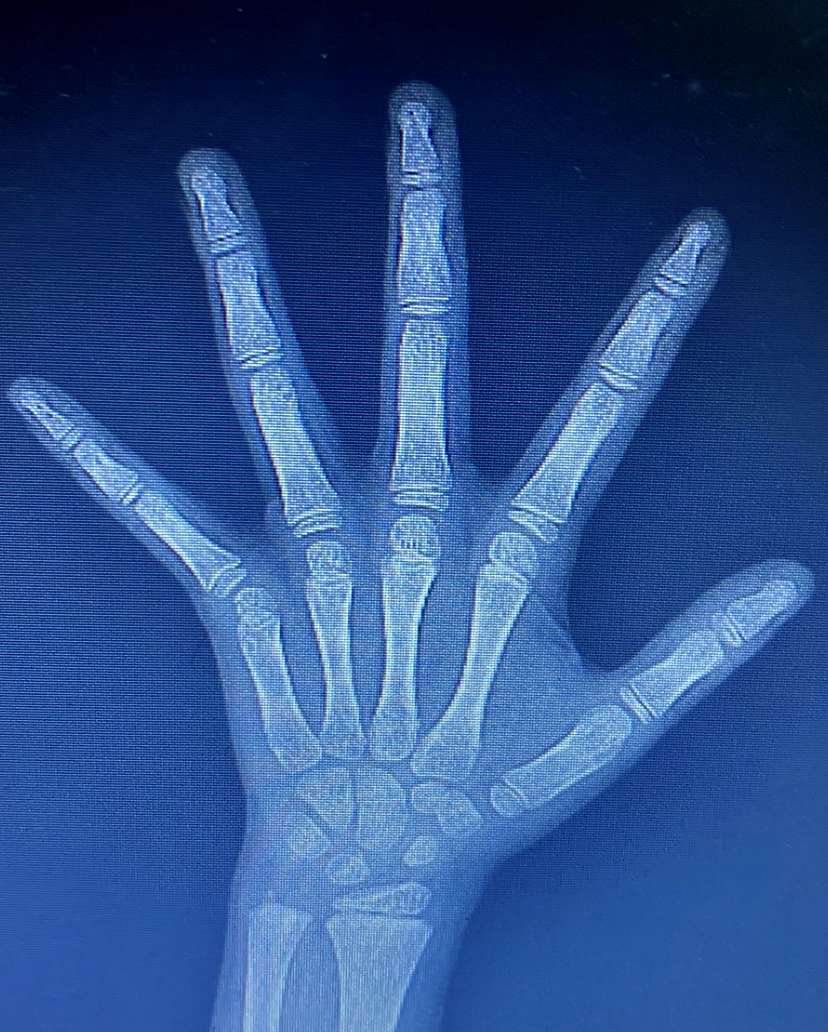 儿童身高管理17年 的想法: "我怎么也想不到才5岁半的小女孩会出现