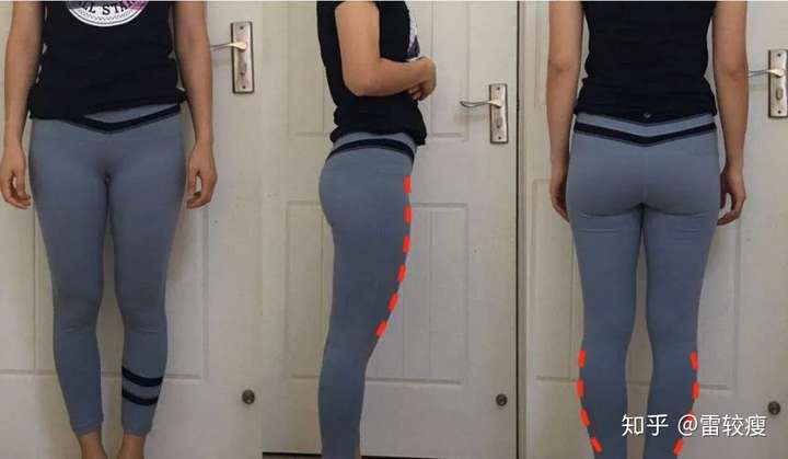 大腿粗前侧的人很多.通常她们站立的时候,习惯伸直膝盖,以便维持姿势.