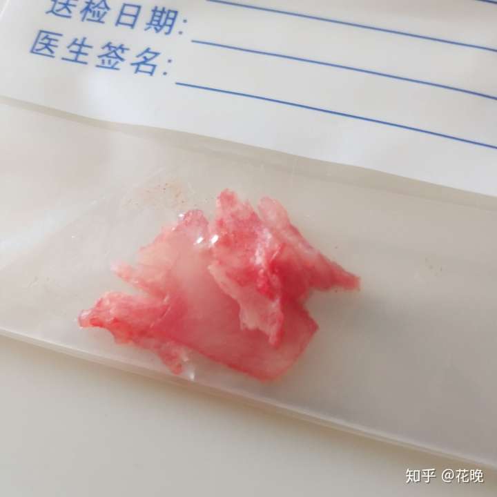 鼻中隔偏曲手術是一種怎樣的體驗