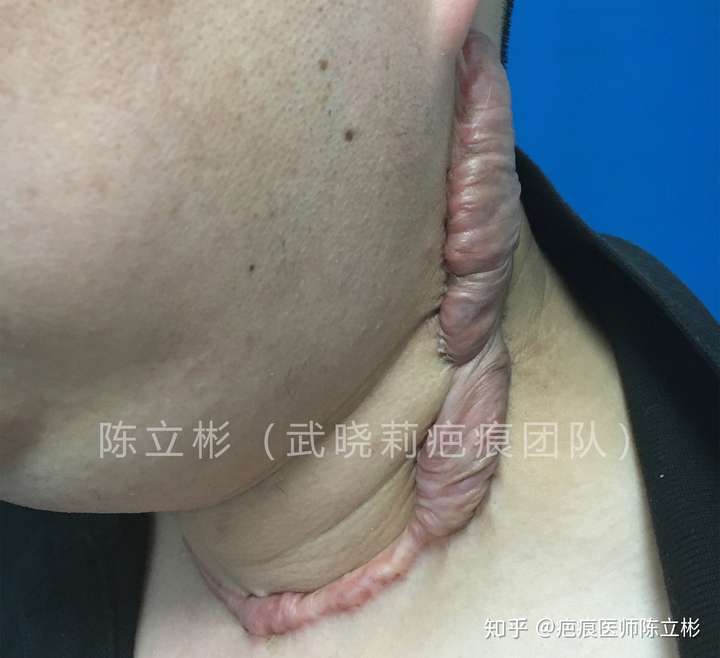疤痕医师陈立彬 如今,甲状腺手术的疤友越来越多了,好多疤友手术 