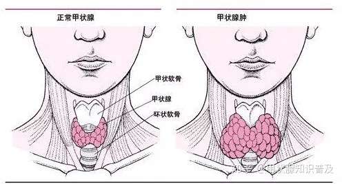 简单六步做甲状腺自检- 知乎