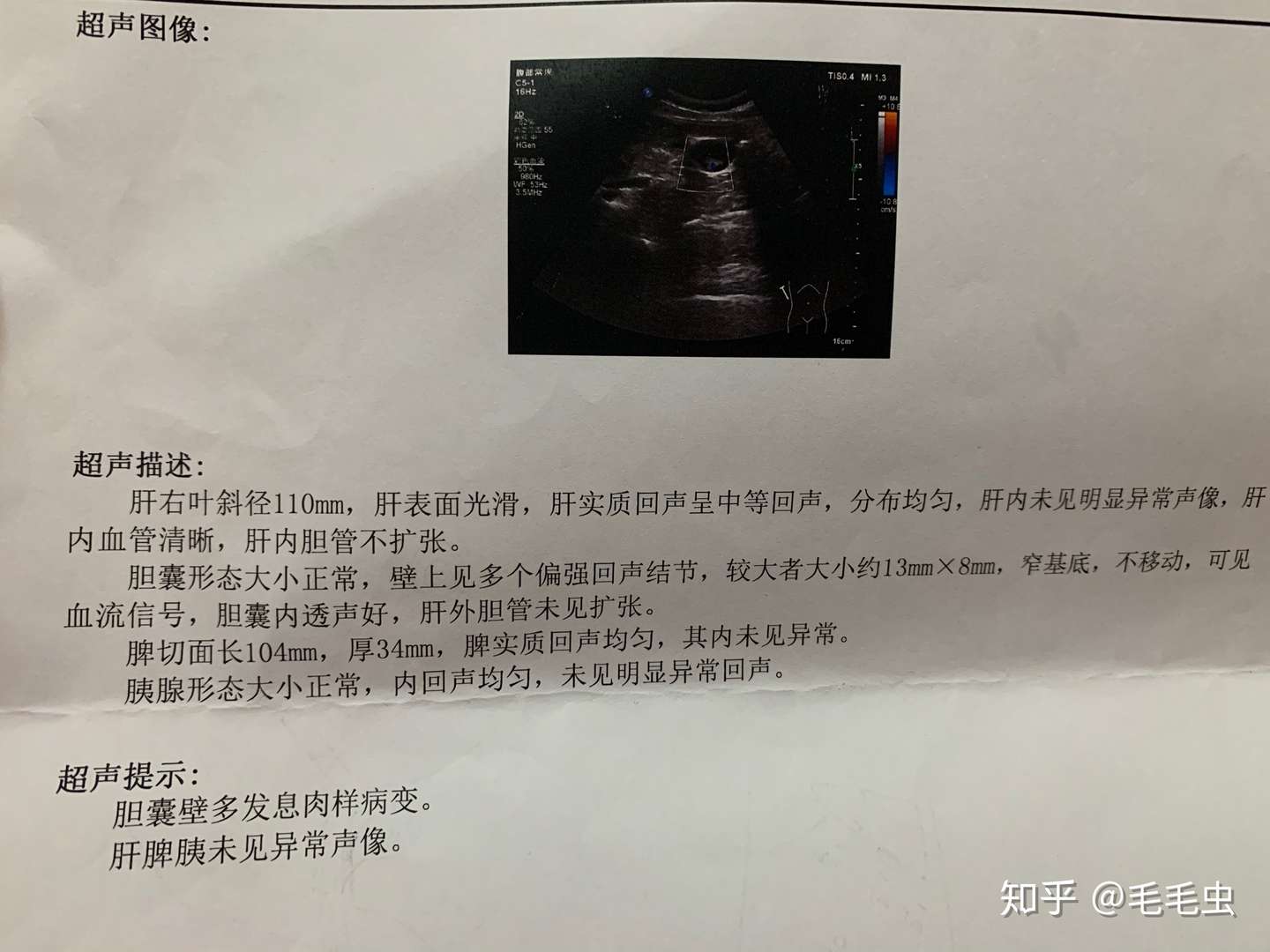 记录我的胆囊切除手术 知乎