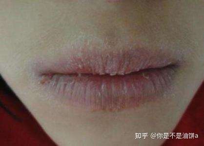 冬季舔嘴唇可以保湿吗?