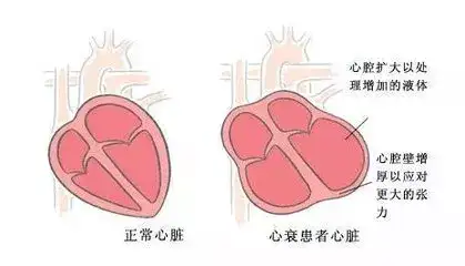 IVD靶标丨ST2检测的来龙去脉！