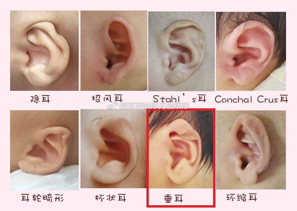 先天性耳廓形态畸形之二 垂耳 知乎