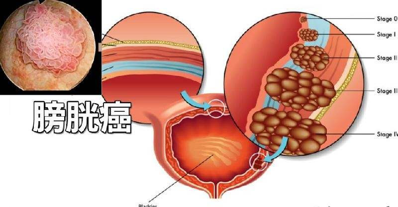 膀胱癌患者已经膀胱全切 腹部造瘘口 这种情况还能做人造膀胱吗 知乎