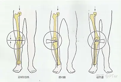 膝后夹角45度图片图片