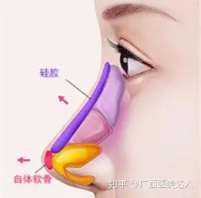 再來看耳軟骨和鼻中隔軟骨分別取骨的位置,從圖片中就能看出,耳軟骨的