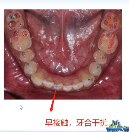 咬合纸种类图片