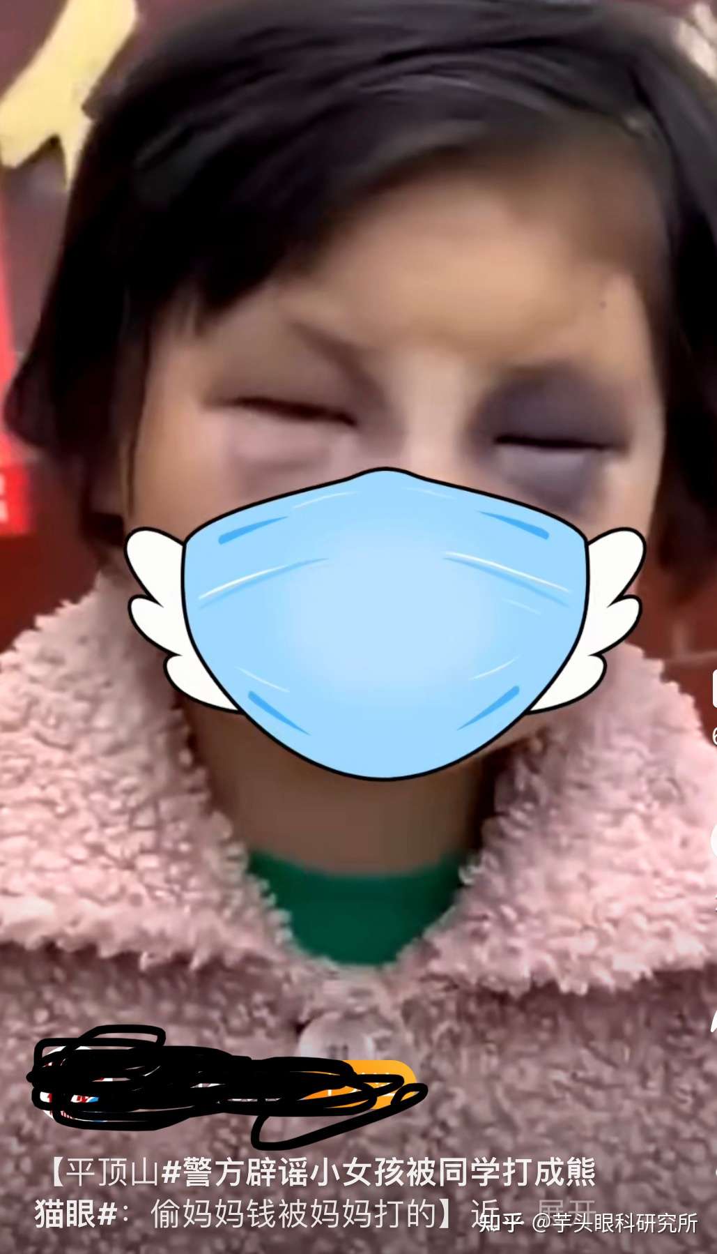 芋头眼科研究所 的想法: 这种熊猫眼,要考虑颅底骨折,如果是家人