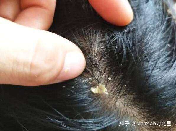 你为什么会有这么多头皮屑 知乎