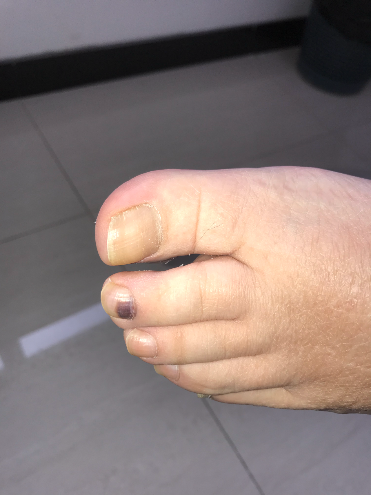 皮肤科徐宏俊医生#这可不是灰指甲,更不是恶性黑色素瘤,而是甲下出血