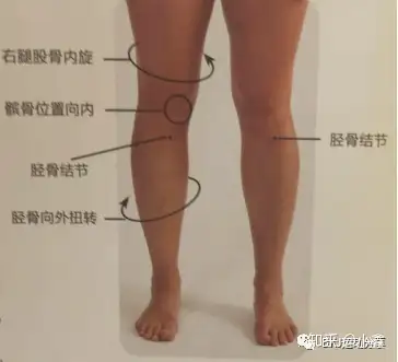 异常体态之胫骨扭转