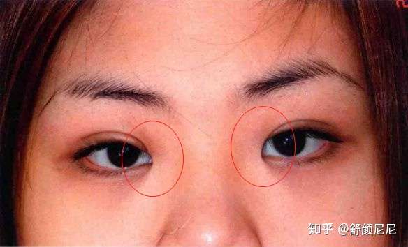 内眦赘皮未行开眼角,进行双眼皮手术后效果.