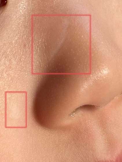 c chen 的想法: 多年后脸上划伤的白色疤痕有修复好的吗?… - 知乎