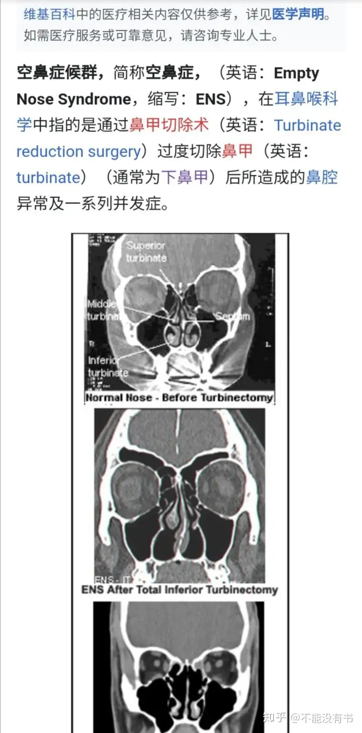 空鼻症候群 英语 Empty Nose Syndrome 维基百科 知乎