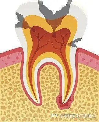 為什麼做了根管治療後還要做牙冠