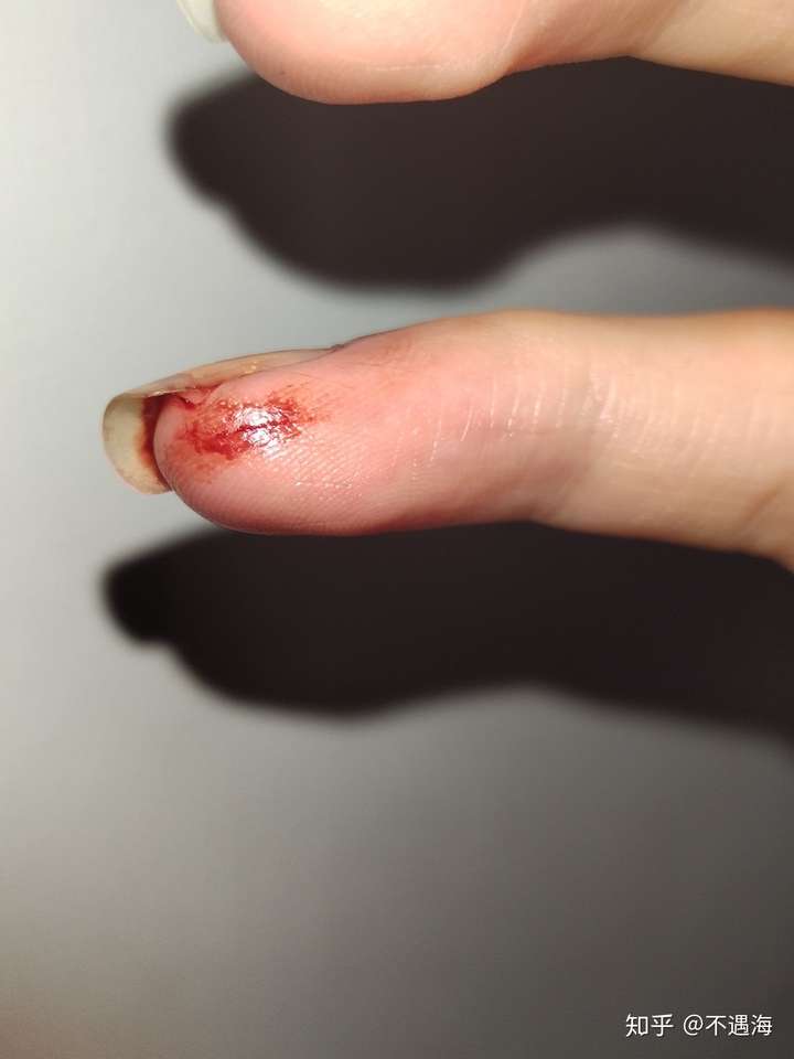 平时手指被割伤应该怎么处理?