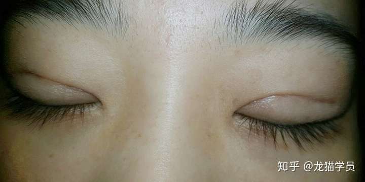 埋线双眼皮闭眼会能看到印吗