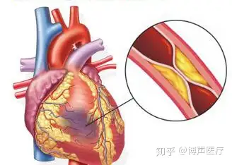 博聲醫療心肌缺血心肌缺血怎麼辦