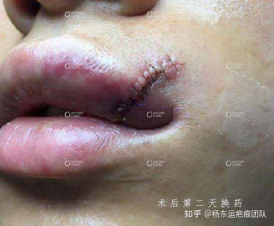 杨东运疤痕团队 的想法: 患者唇部外伤,创面跨过唇红缘,行急诊美