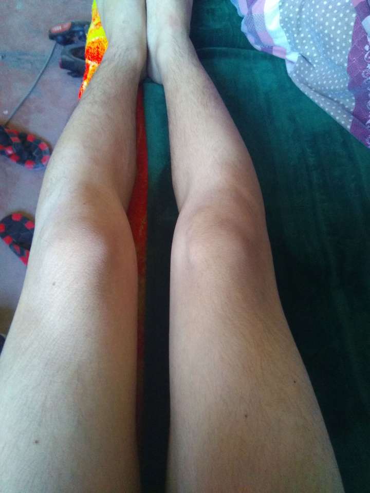 这个属于o型腿吗?