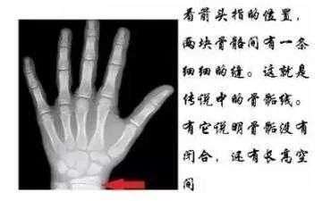 可以帮我看看骨垢线闭合了吗? - 知乎