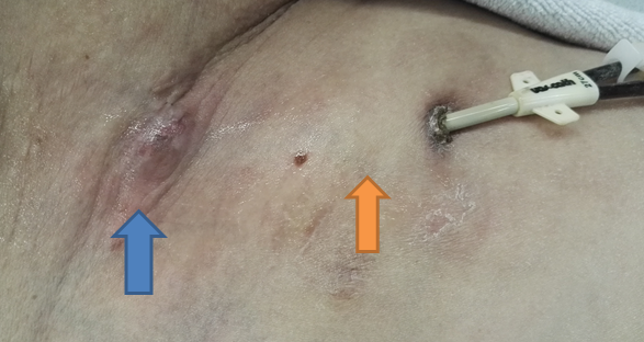 带cuff血透导管隧道感染的超声表现 知乎