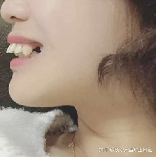 牙齿看上去整齐，但医生说是深覆颌？这是个什么鬼？
