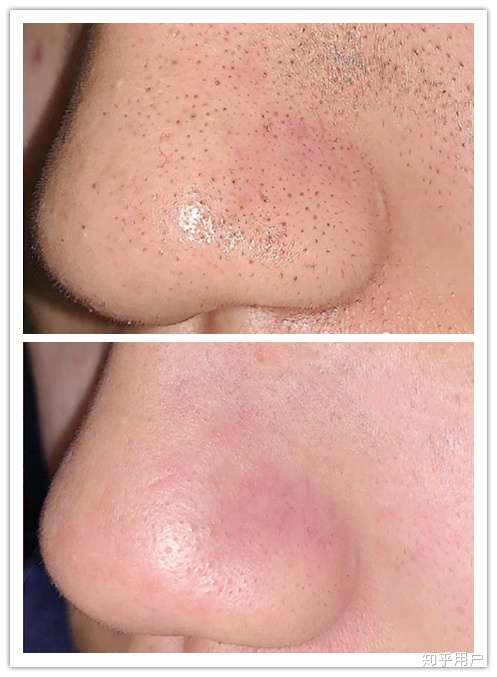 去黑头的鼻膜贴真的有用么